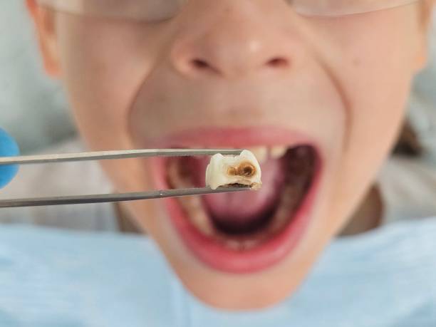 Best Emergency Dentist for Lost Fillings or Crowns in East Pittsburgh, PA